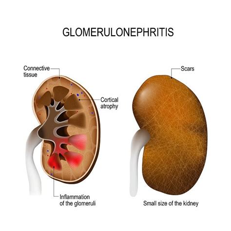 Gambar Glomerulonefritis Proliferatif